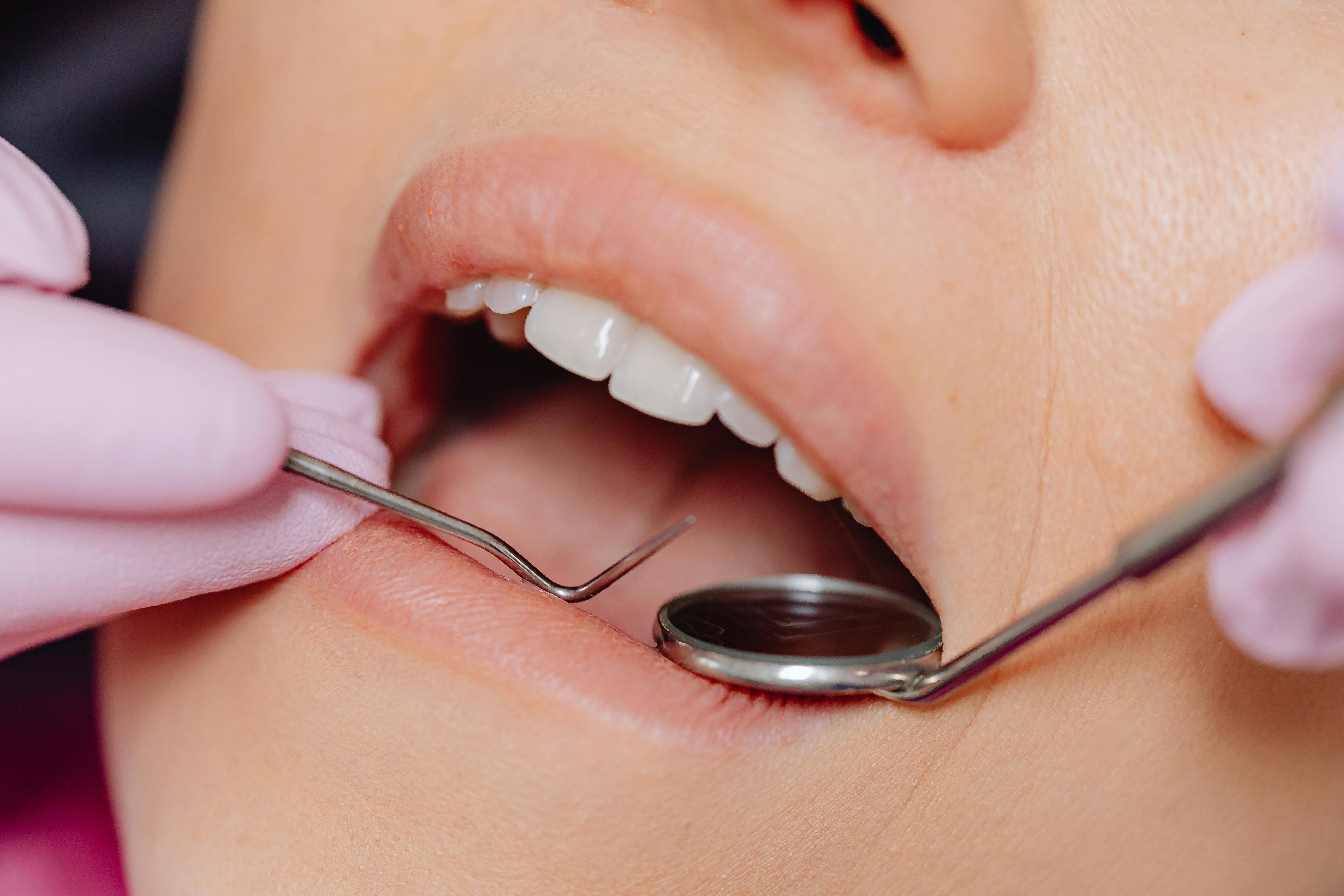 Tooth Extraction