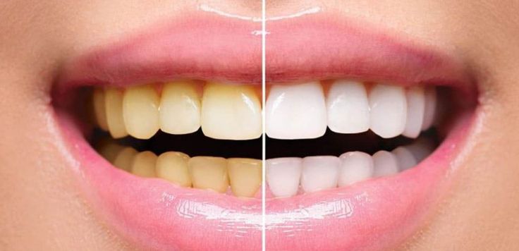 Teeth Whitening in Navi Mumbai	